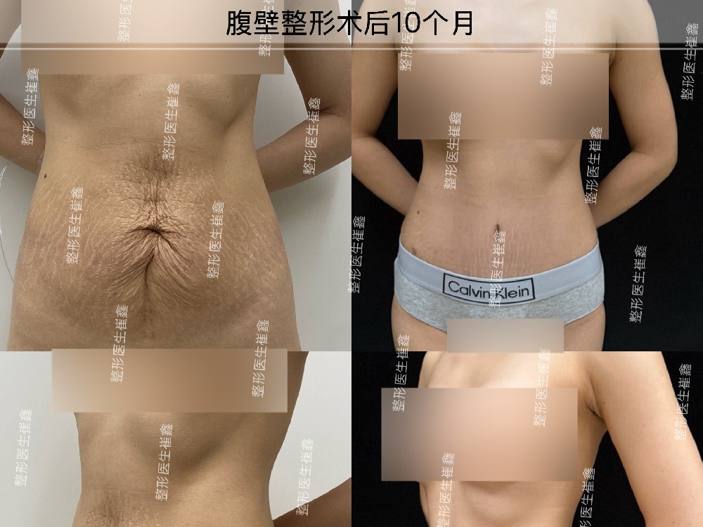 腹壁整形术后10个月