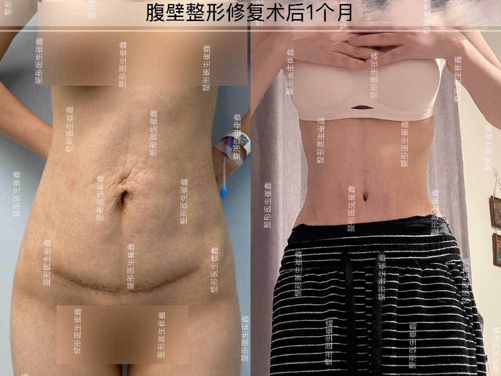腹壁整形修复术后1个月