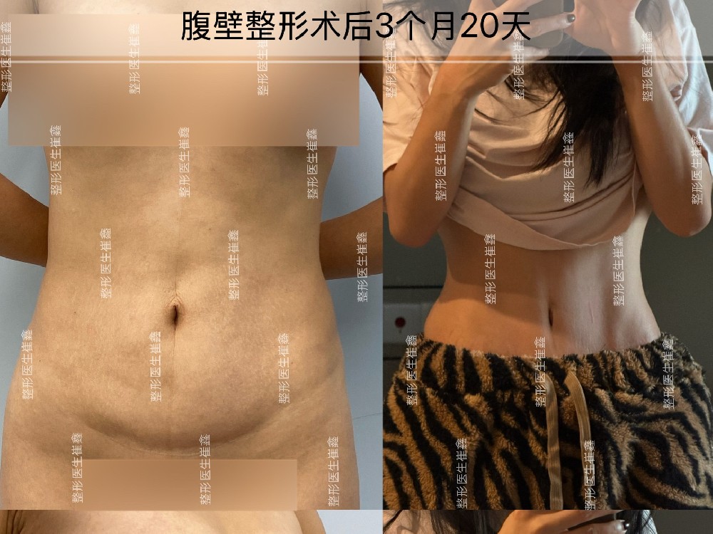 腹壁整形术后3个月20天