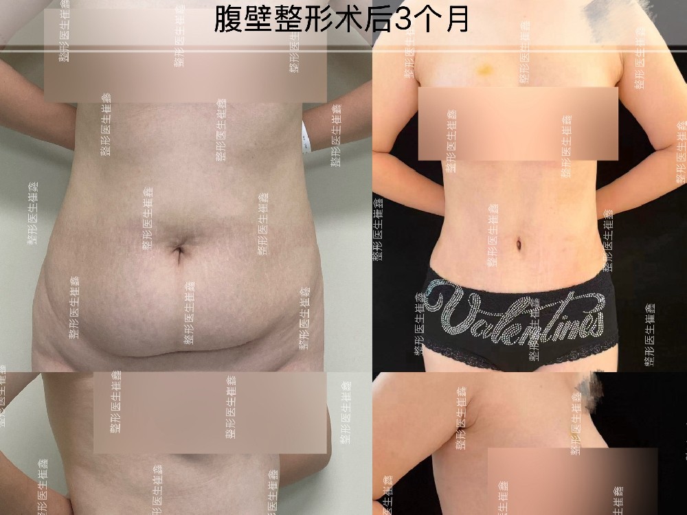 腹壁整形术后3个月