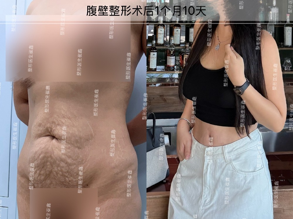 腹壁整形术后1个月10天