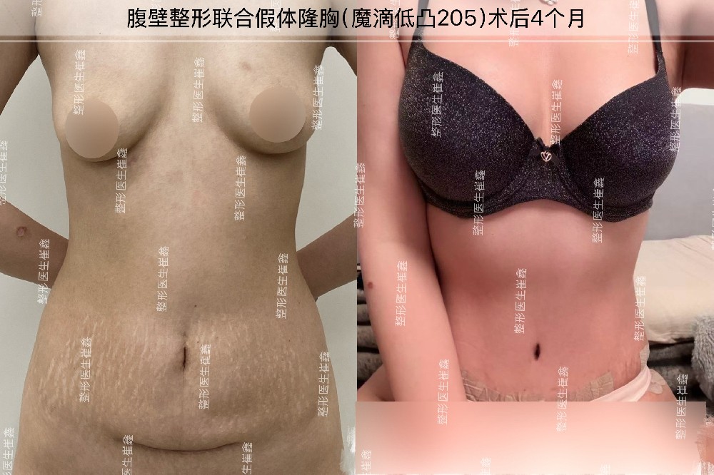 腹壁整形联合假体隆胸（魔滴低凸205）术后4个月