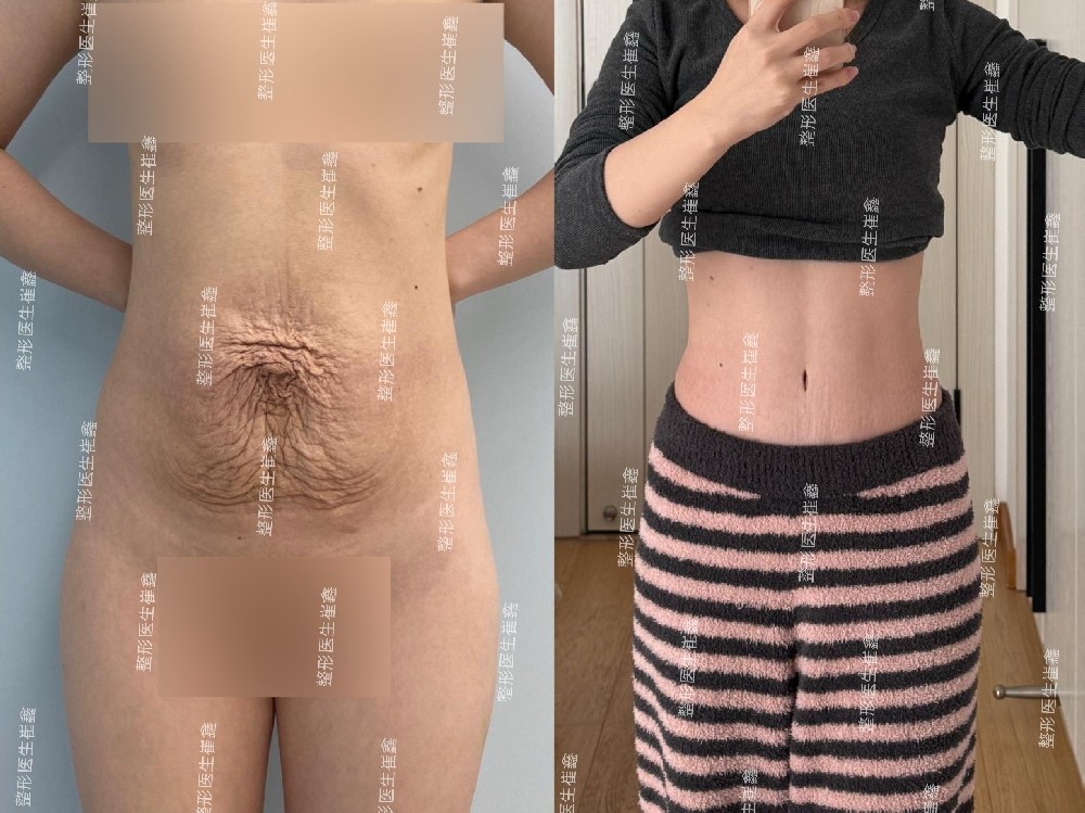 腹壁整形术后1年3个月