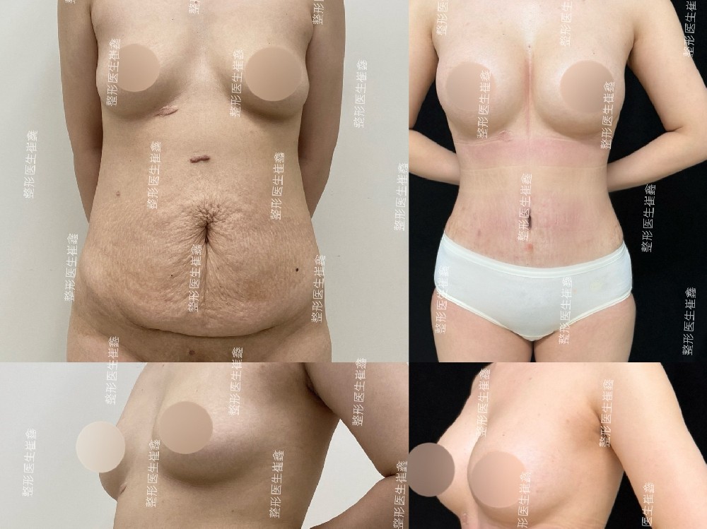 腹壁整形联合假体隆胸（魔滴中凸240）术后4个月5天