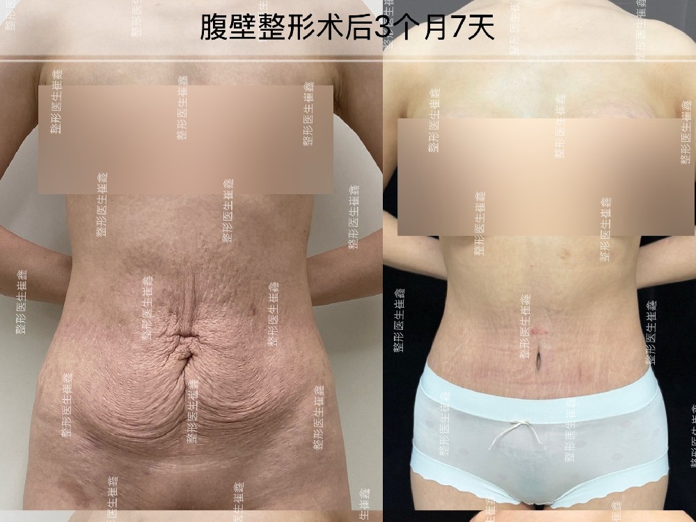 腹壁整形术后3个月7天