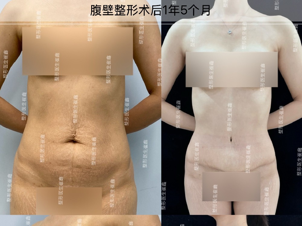 腹壁整形术后1年5个月