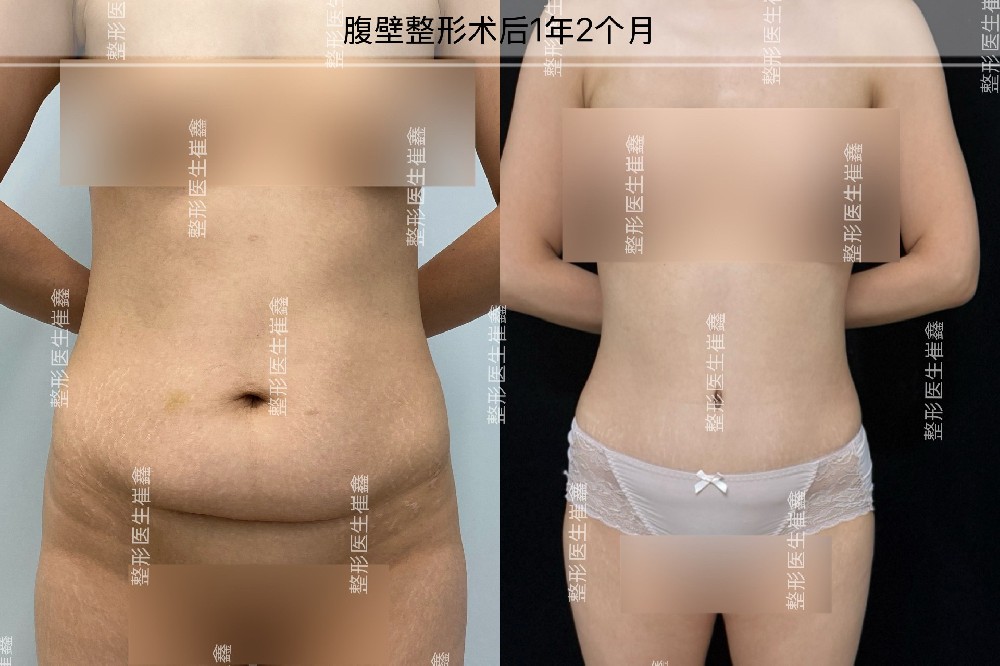 腹壁整形术后1年2个月