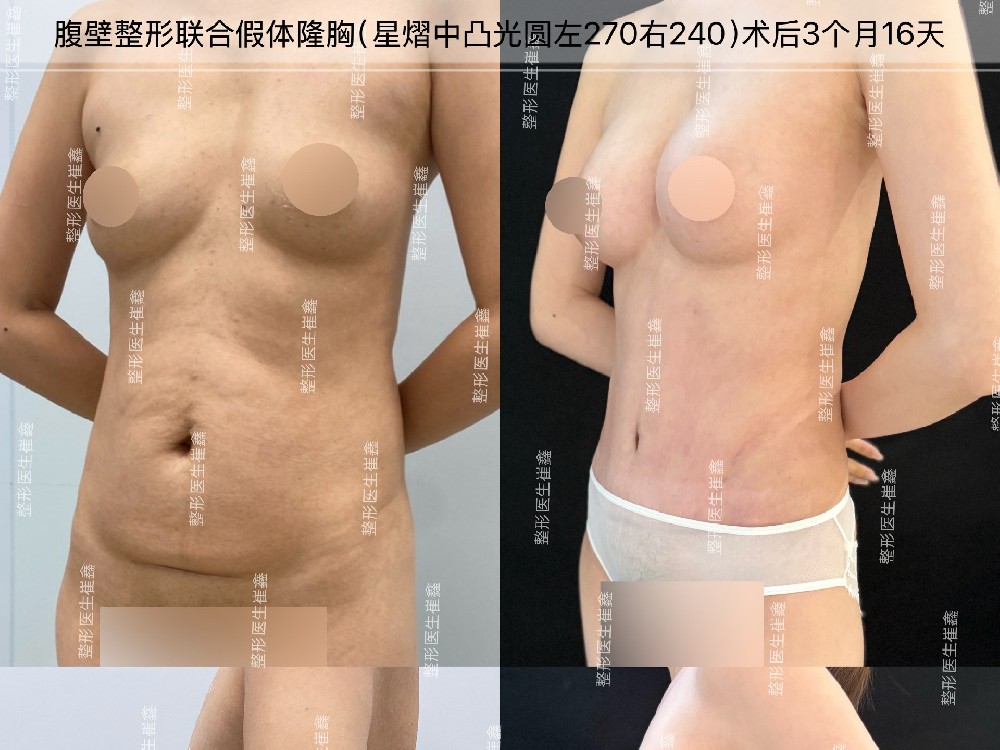 腹壁整形联合假体隆胸（星熠中凸光圆左270右240）术后3个月16天