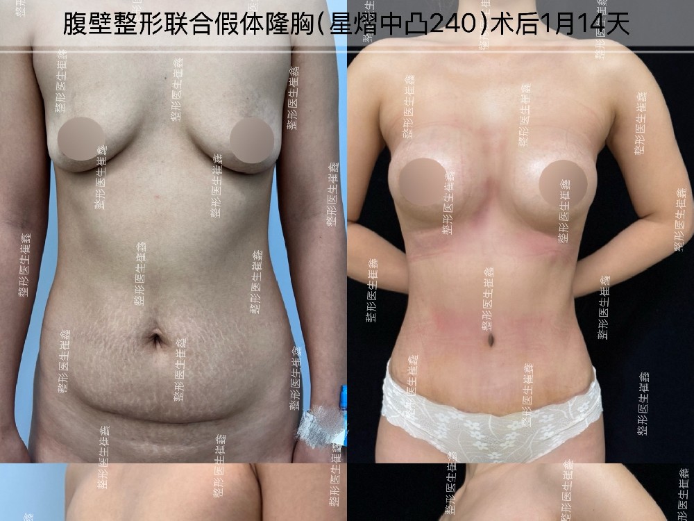 腹壁整形联合假体隆胸（星熠中凸240）术后1个月14天