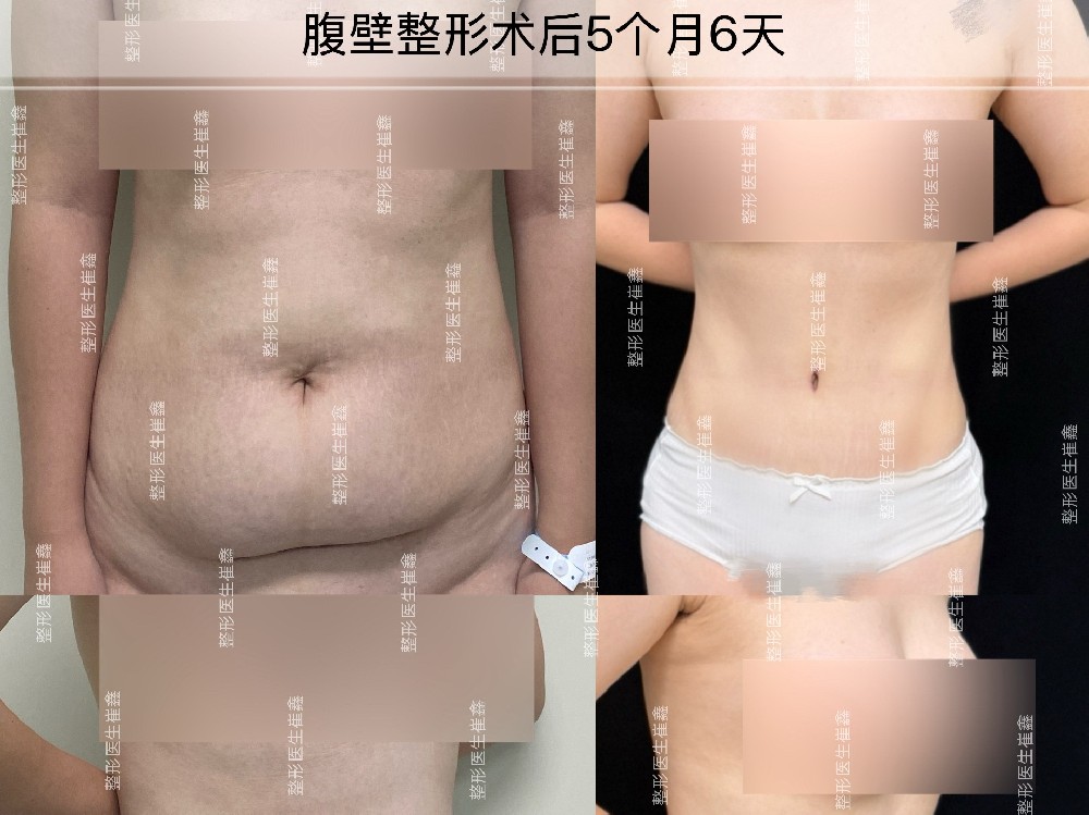 腹壁整形5个月6天