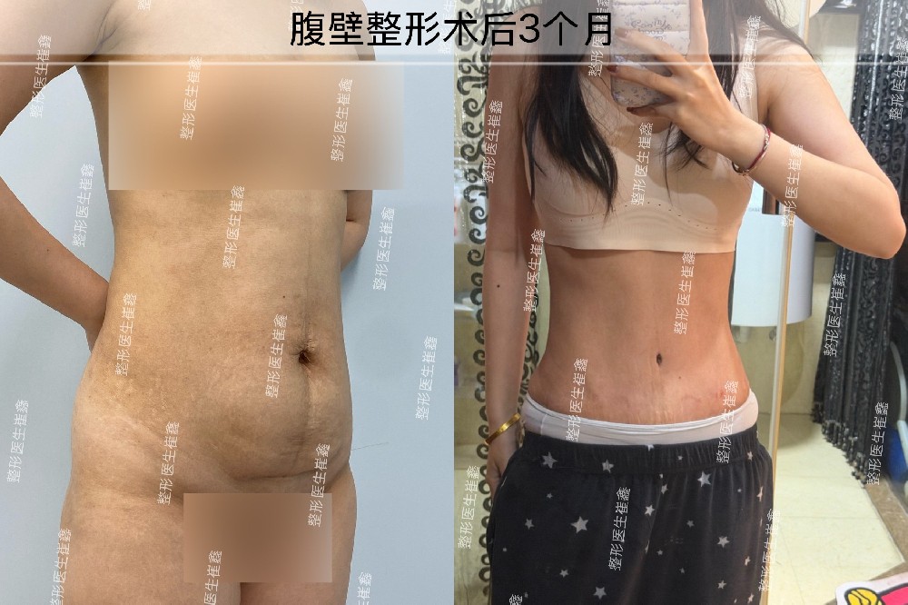 腹壁整形术后3个月