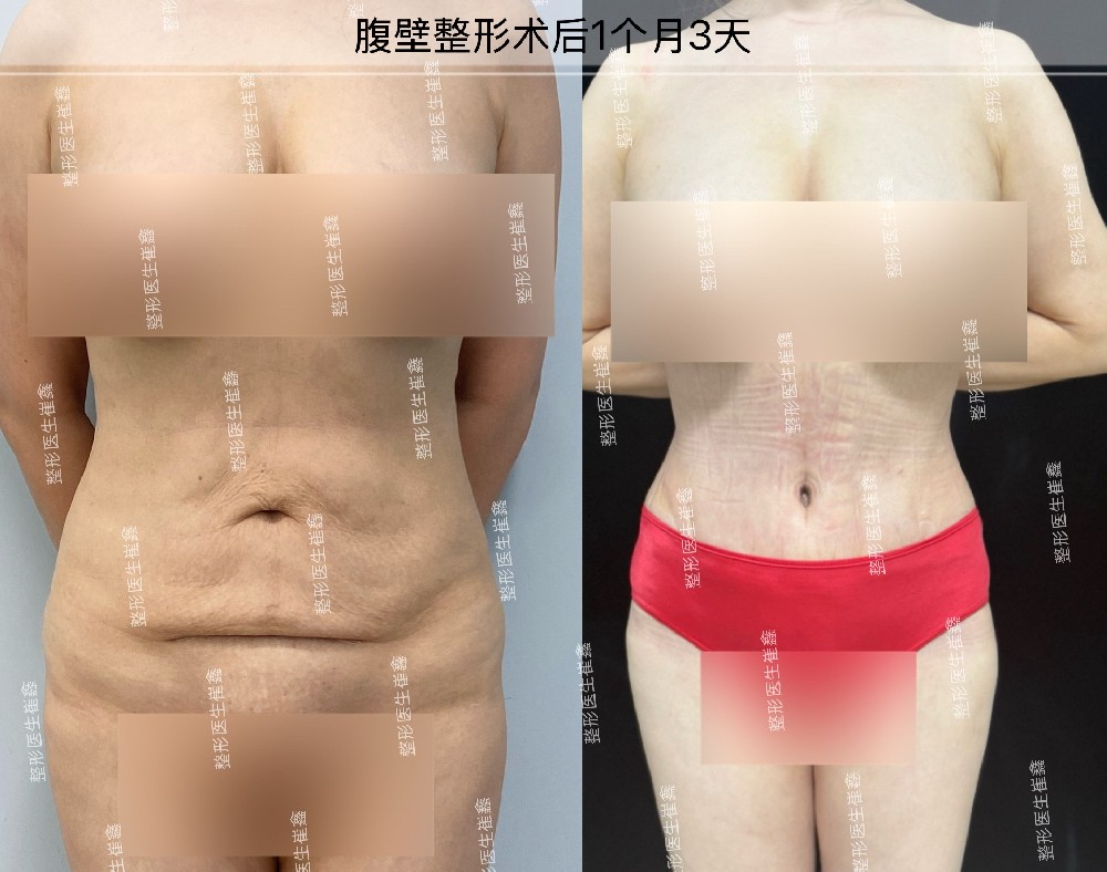 腹壁整形术后1个月3天