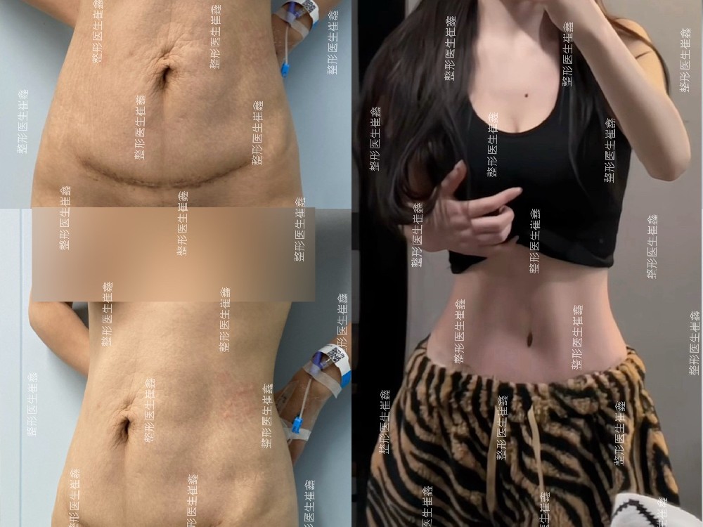 腹壁整形修复术后3个月20天