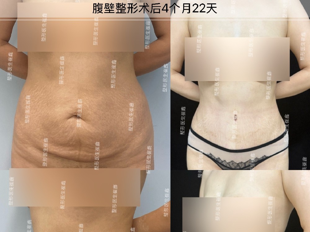 腹壁整形术后4个月22天