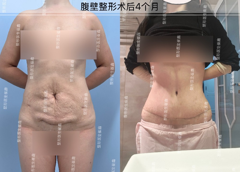 腹壁整形术后4个月
