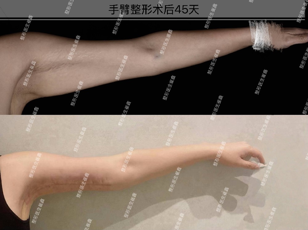 手臂整形术后45天