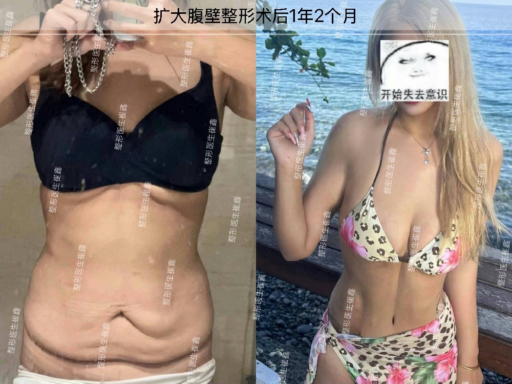 扩大腹壁整形术后1年2个月