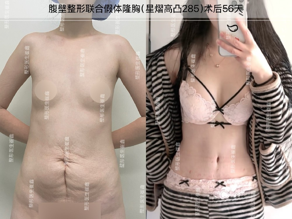 腹壁整形联合假体隆胸（星熠高凸285）术后56天