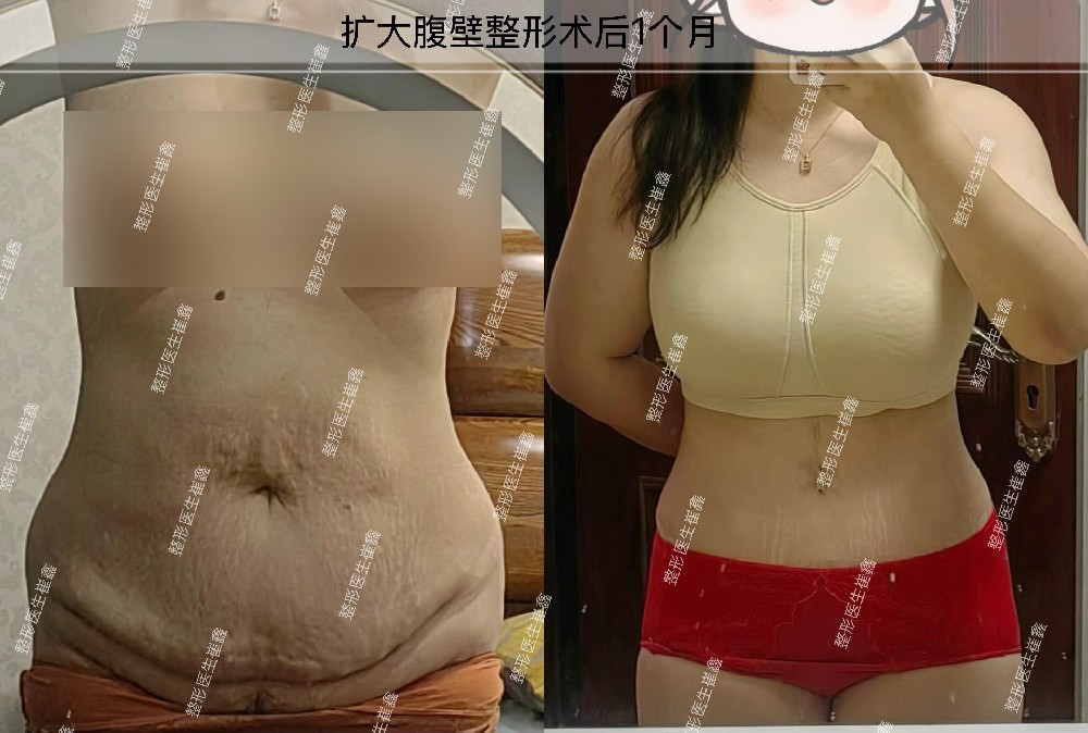 扩大腹壁整形术后1个月