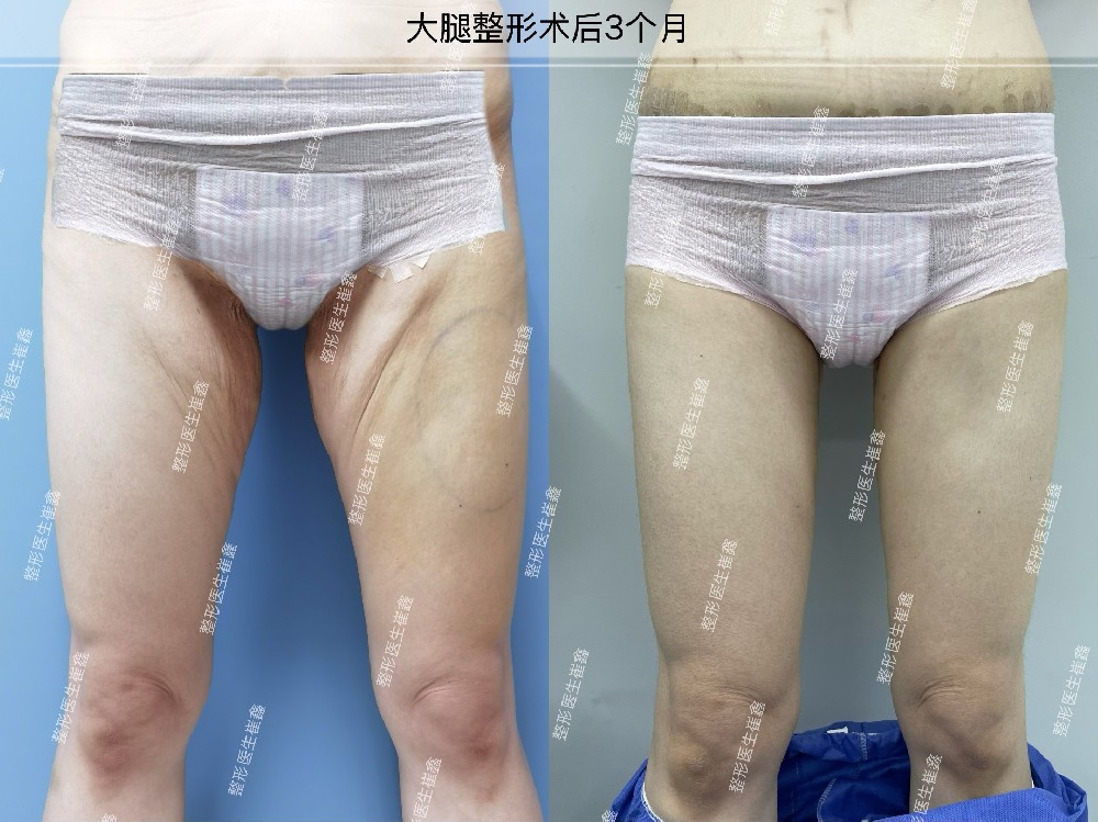大腿整形术后3个月