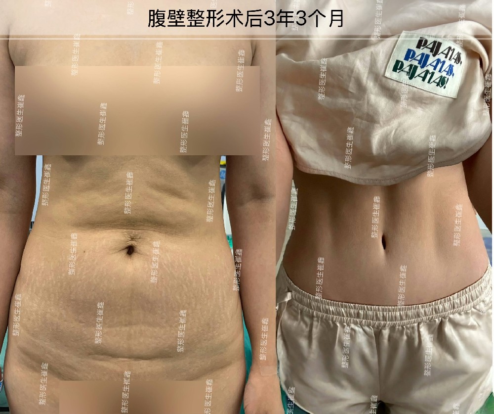 腹壁整形术后3年3个月
