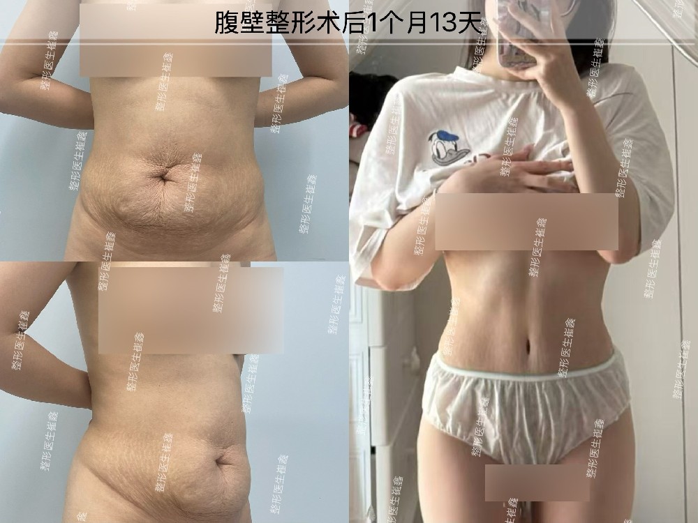 腹壁整形术后1个月13天