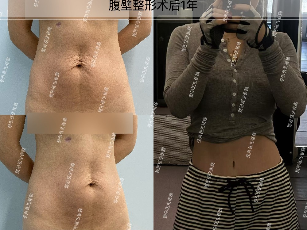 腹壁整形术后1年
