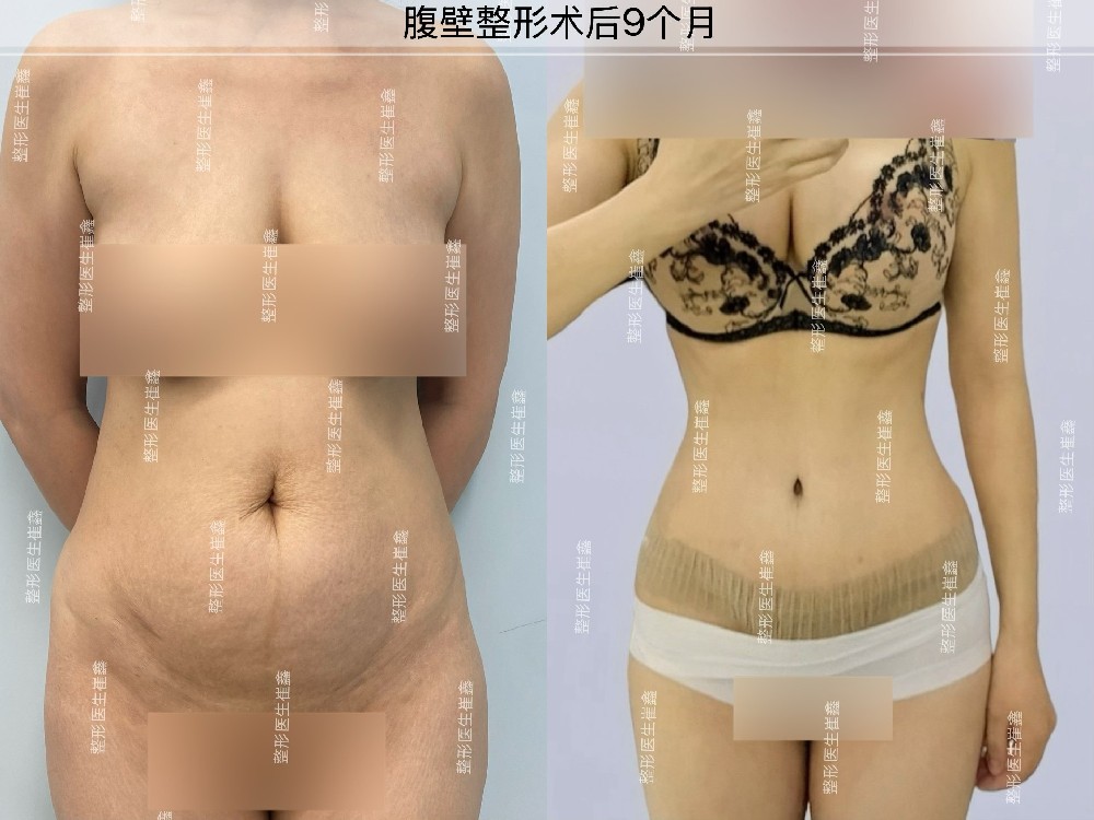 腹壁整形术后9个月