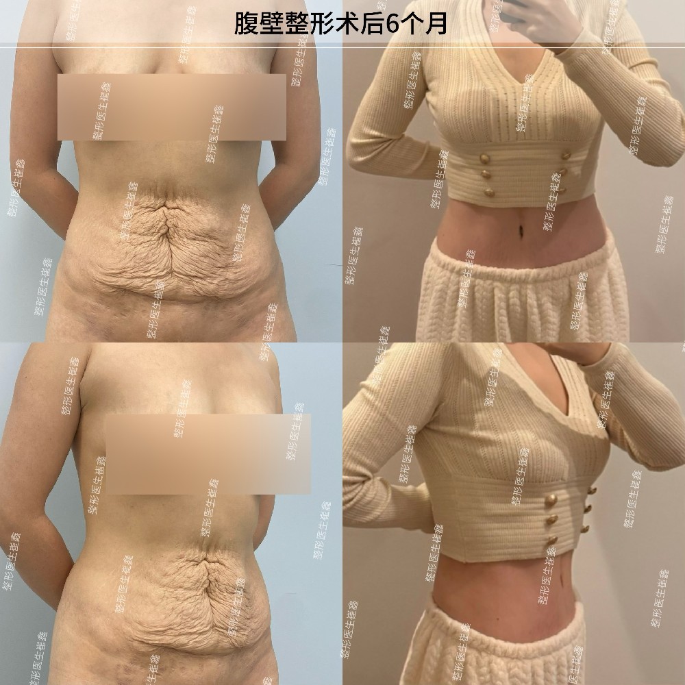 腹壁整形术后6个月