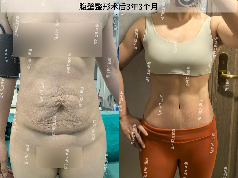 腹壁整形术后3年3个月