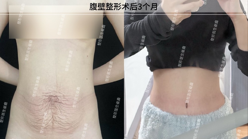 腹壁整形术后3个月
