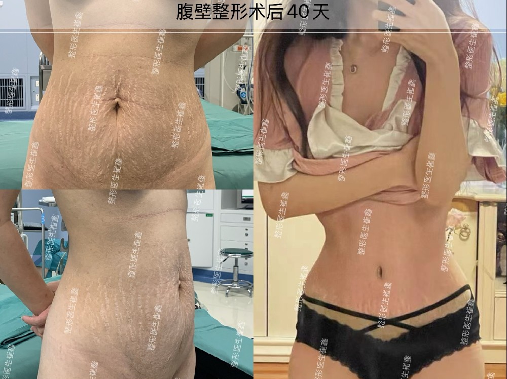 腹壁整形术后40天