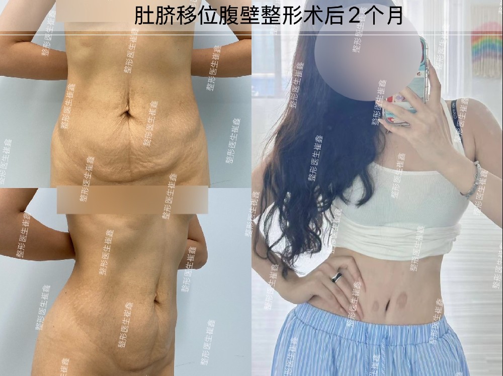 肚脐移位腹壁整形术后2个月