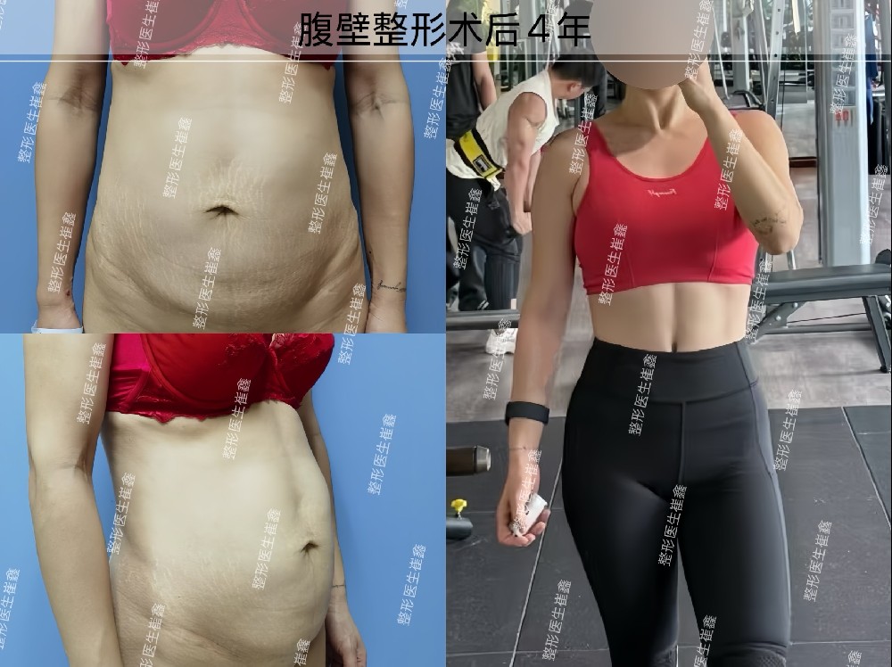 腹壁整形术后4年