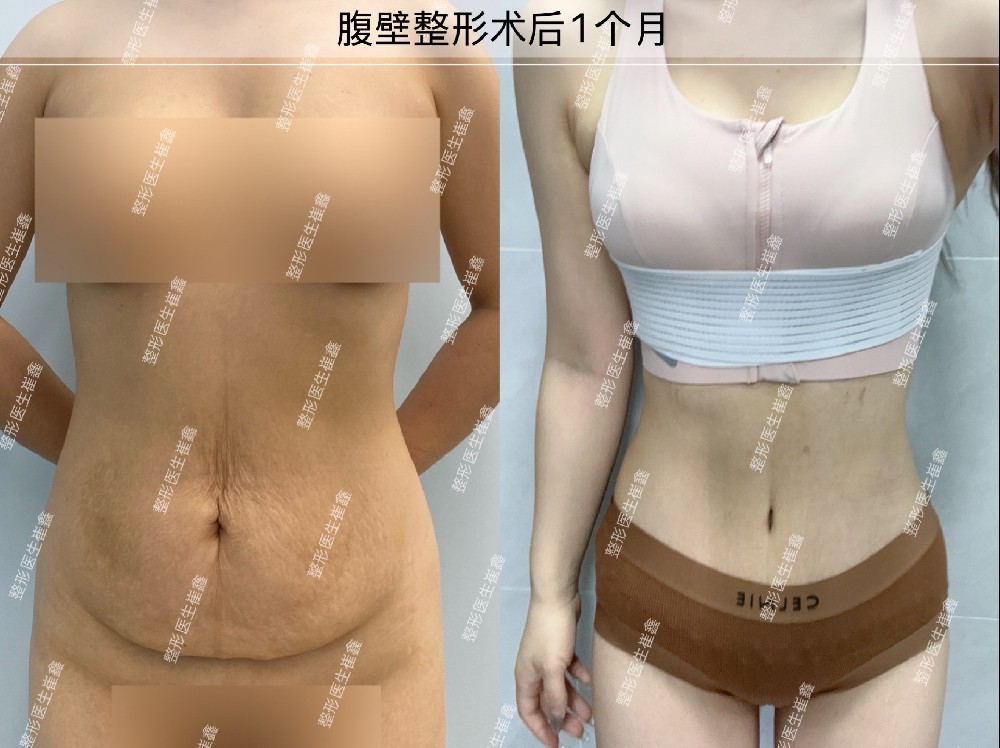 腹壁整形术后1个月