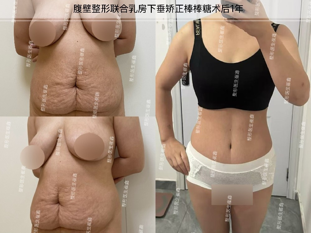 腹壁整形联合乳房下垂矫正术后1年