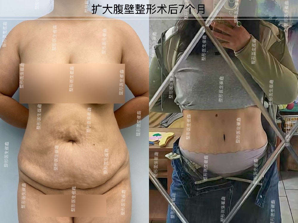 扩大腹壁整形术后7个月