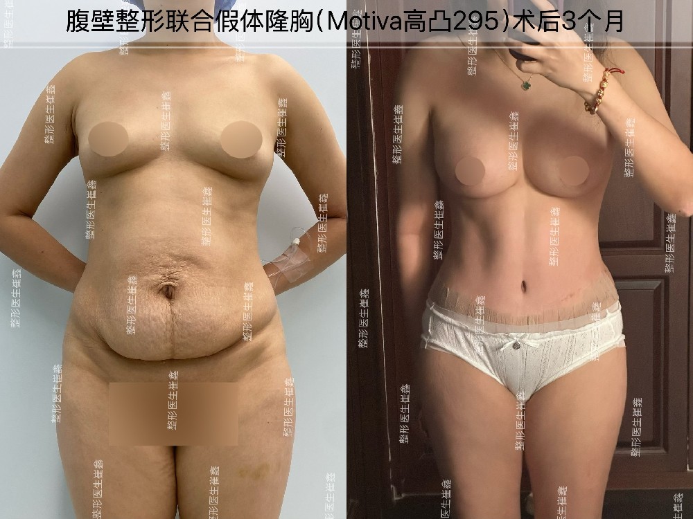 腹壁整形联合假体隆胸（Motiva高凸295）术后3个月