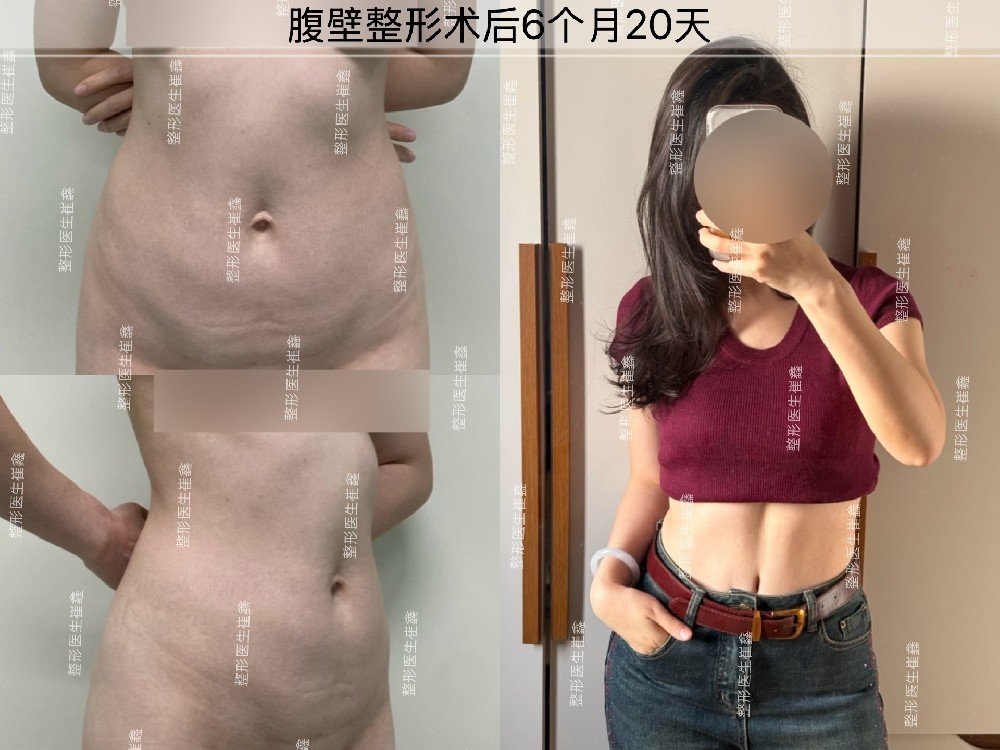 腹壁整形术后6个月20天