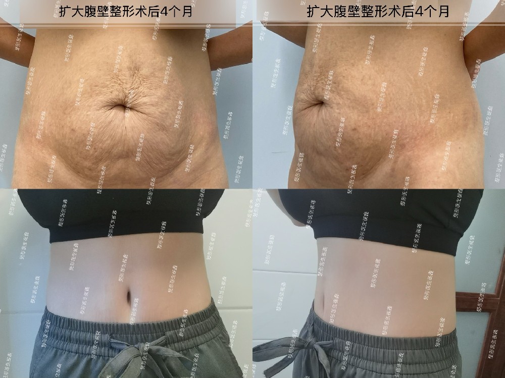 扩大腹壁整形术后4个月