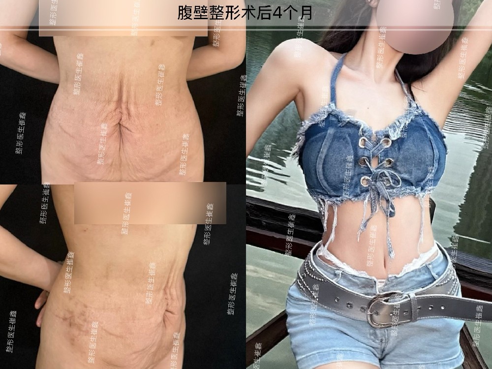 腹壁整形术后4个月