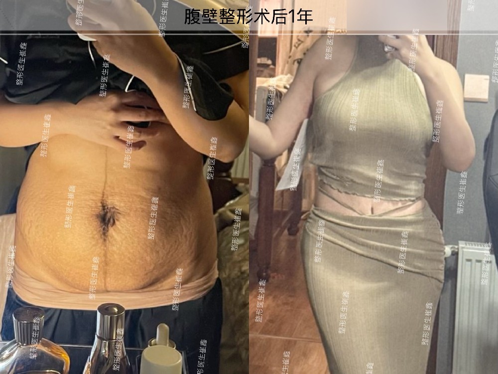 腹壁整形术后1年