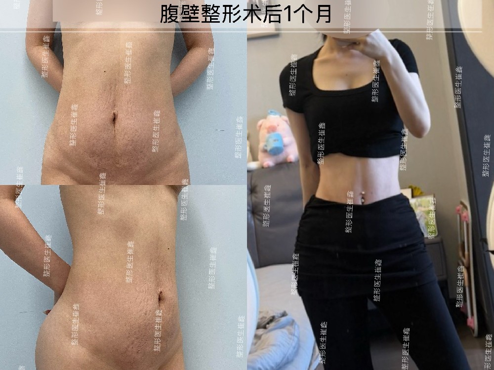腹壁整形术后1个月