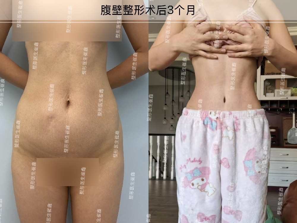 腹壁整形术后3个月